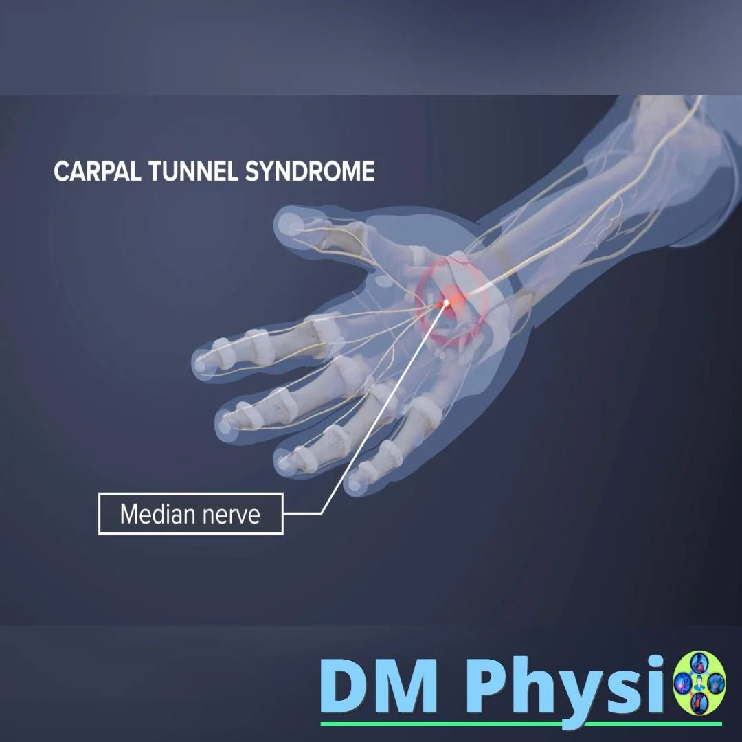 Изображение на синдром на карпалния канал